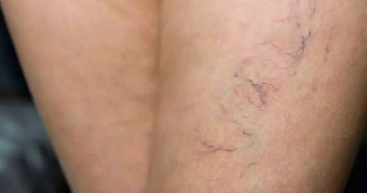 Your Legs May Be Giving You a Health Clue — Here’s What Purple Veins Could Mean