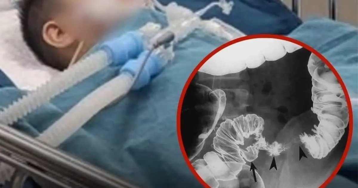Second-Grader Diagnosed with Colon C.anc.er After Regularly Eating These 2 Foods Since Childhood