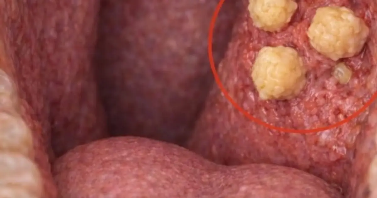 What Are Those Small White Stones in Your Throat That Cause Bad Breath?