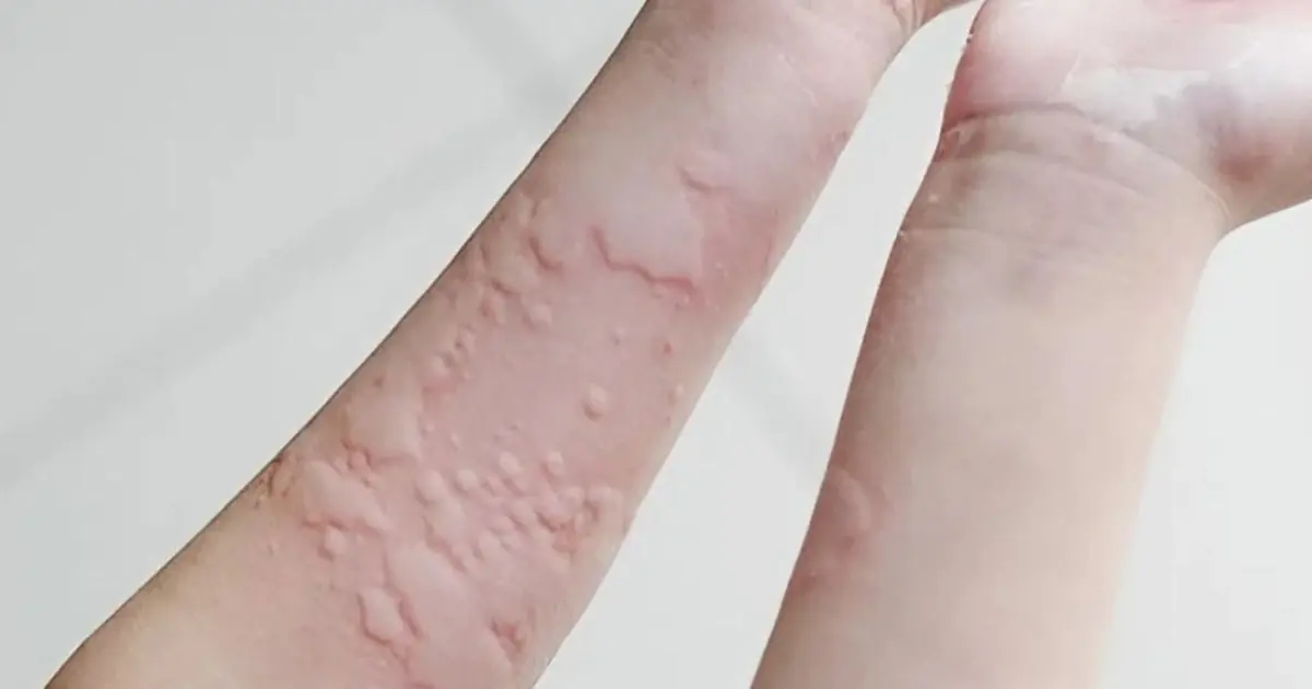 Itchy Skin and Sudden Bumps: What Could Be Causing Them?