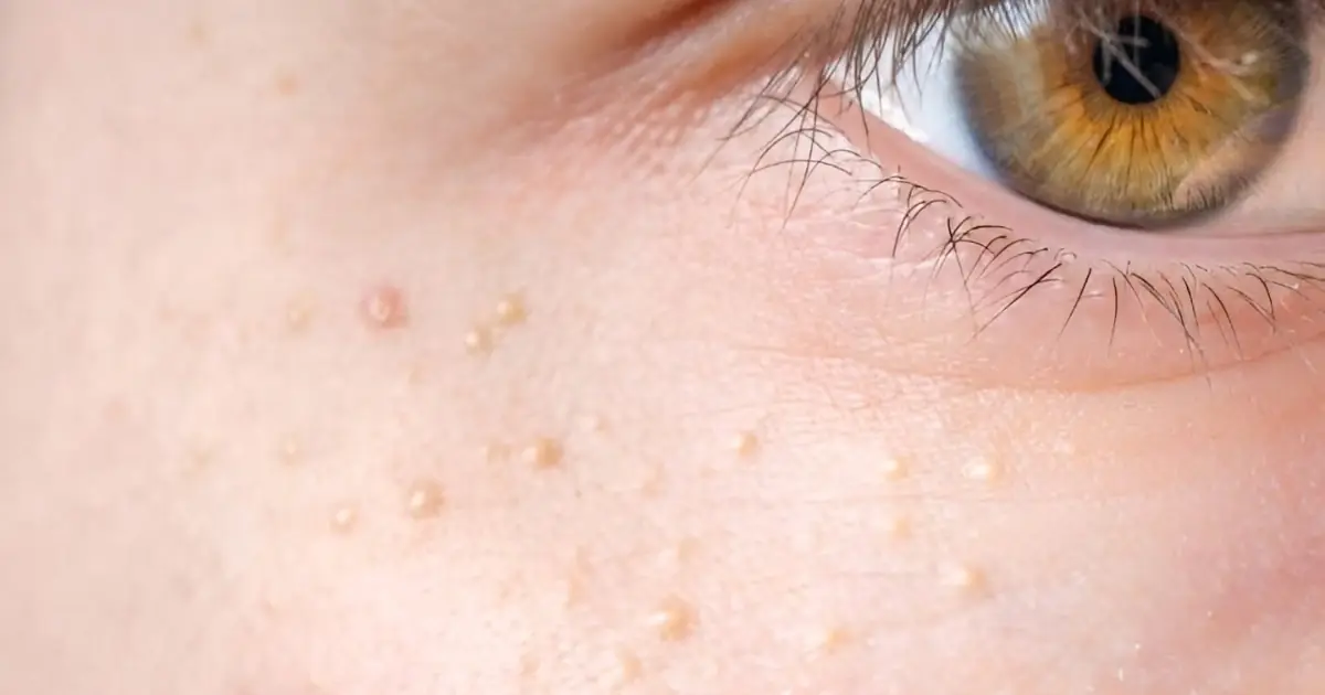 If You Have These Tiny White Bumps on Your Face, Don’t Try to Remove Them Yourself
