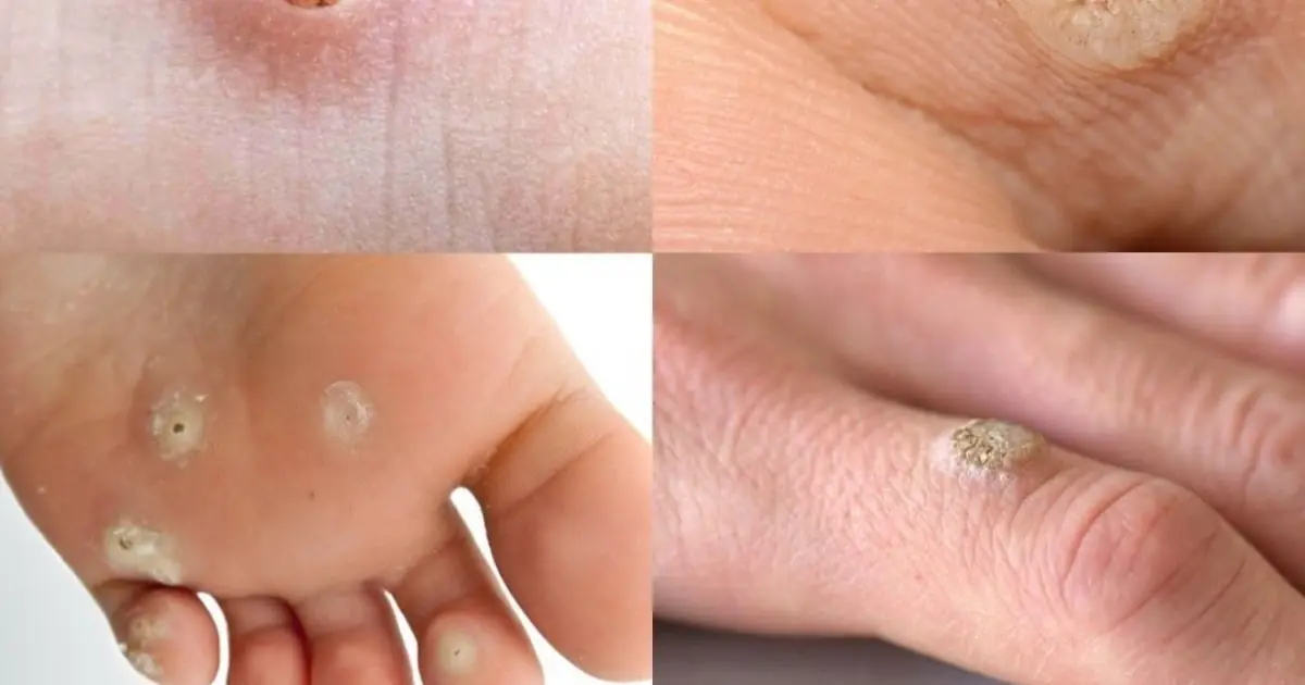 If You Get These Rough Bumps on Your Skin, You May Have a Viral Wart