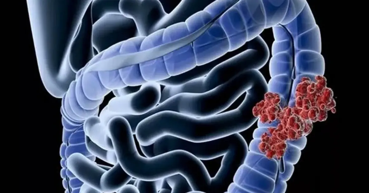 Your Body May Be Warning You About Colon Can.cer - Here’s What to Watch For