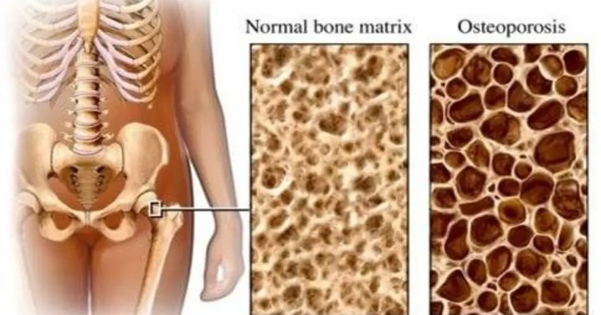 After Menopause, Osteoporosis Risk Rises - If You Don’t Belong to These 3 Groups, You’re in a Better Position