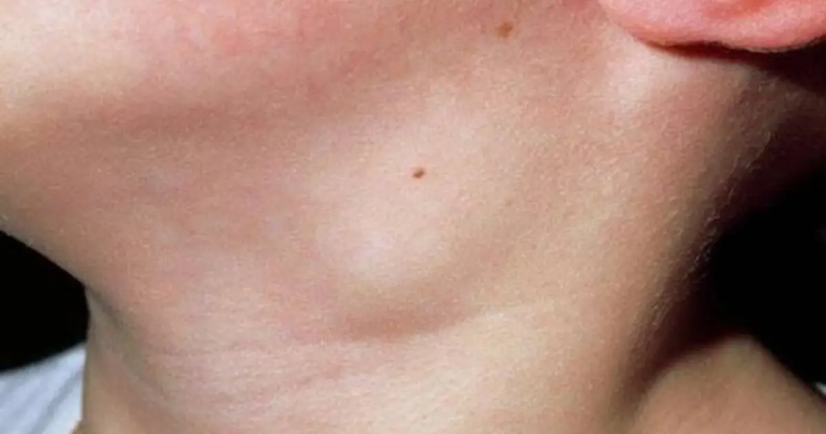 A Strange Lump on Your Neck? Here’s When to Get It Checked