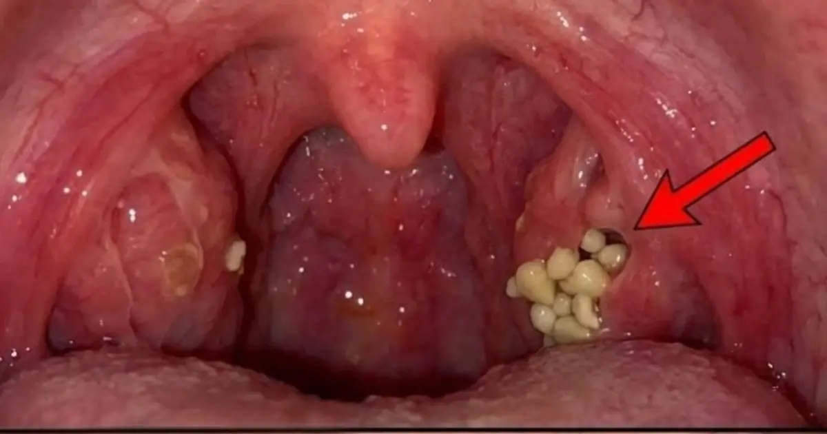 Tonsil Stones: Discover what they are, how they appear, and how to get rid of them forever.
