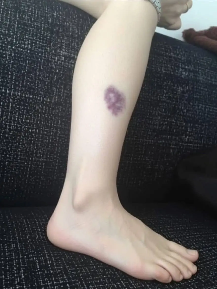 BE CAREFUL, if you get these bruises on your body, it means you have Ca…see more