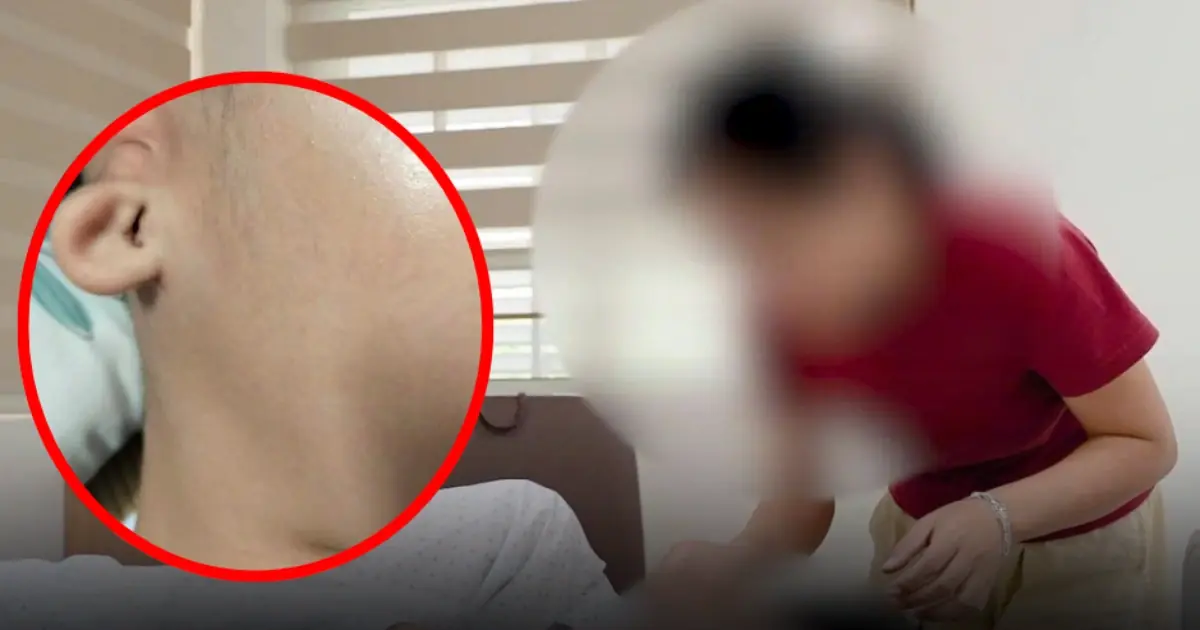 His Ear Kept Draining… Then Doctors Discovered a Cholesteatoma Damaging the Bone