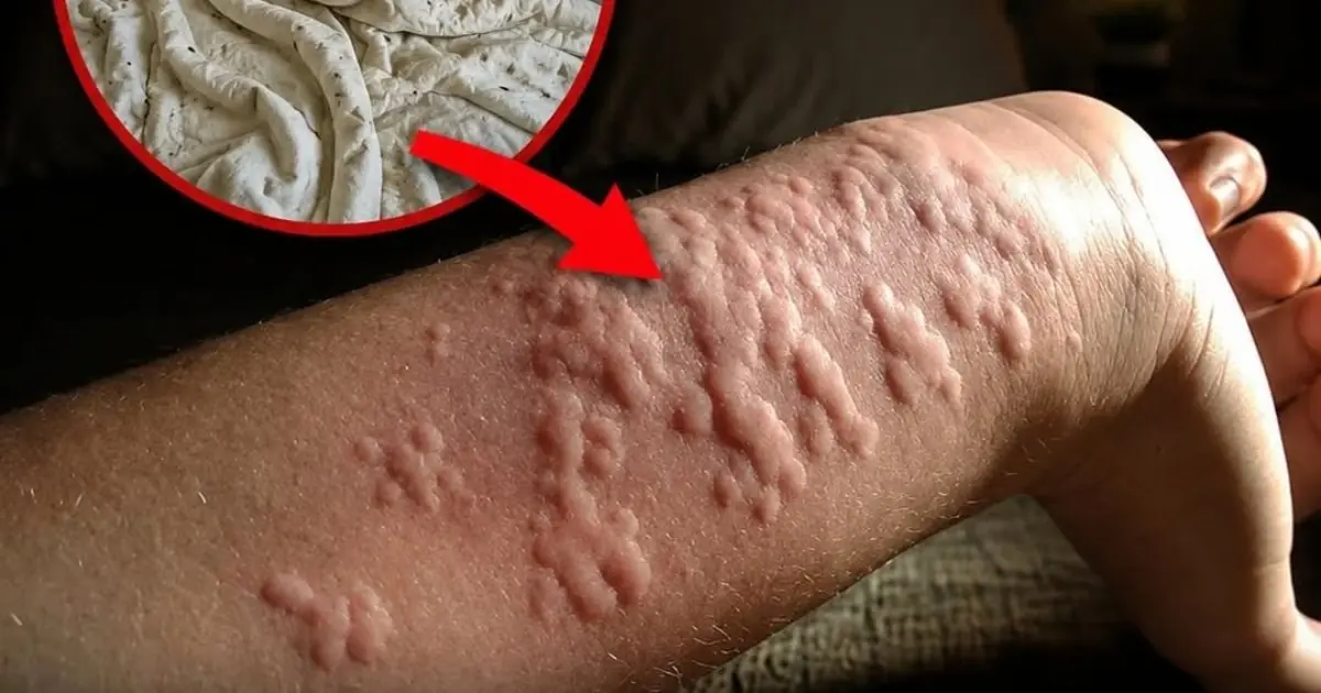 The Hidden Risks Lurking in Your Bed: What Repeated Nighttime Bites Could Mean