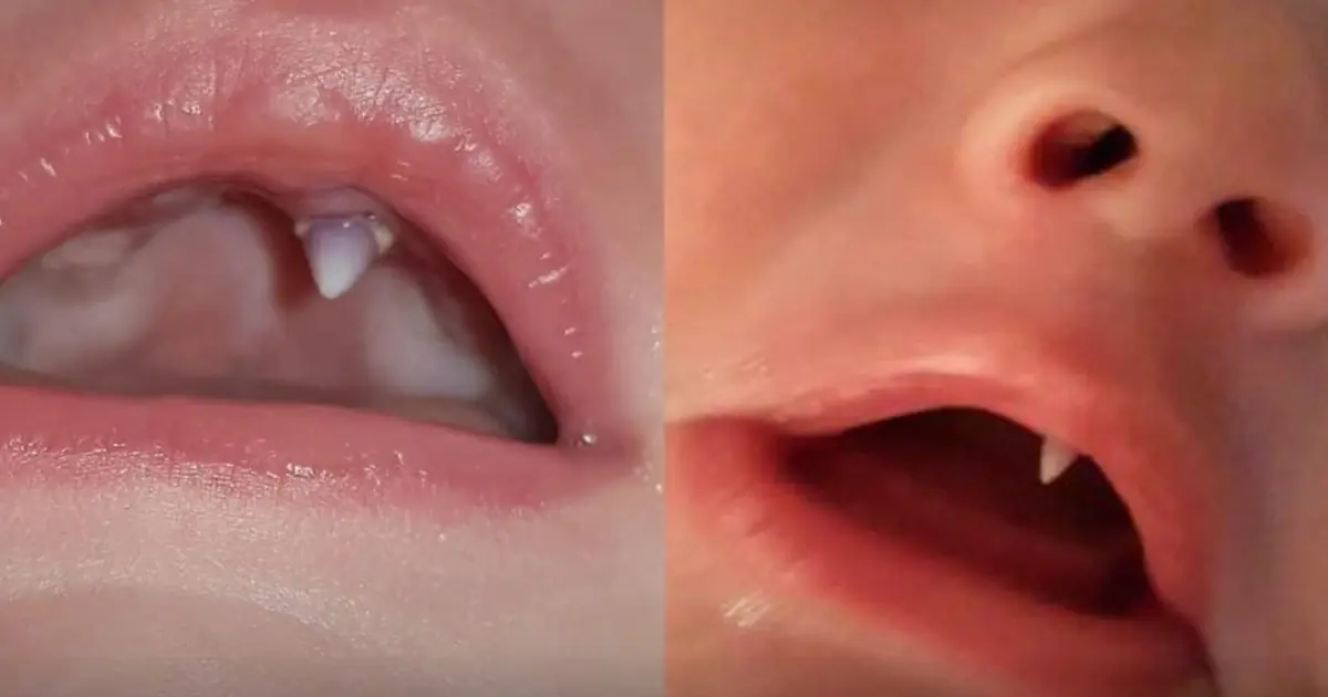 Baby’s Rare “Fang-Like” Tooth Leaves Mother Searching for Answers