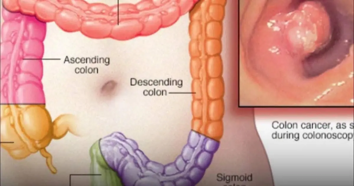 8 Bathroom Warning Signs That Could Point to Colon Cancer