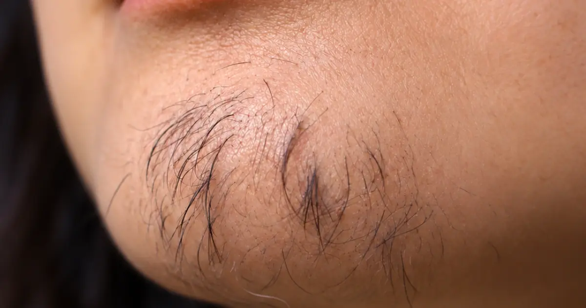 Hair on a woman’s chin is a sign of…
