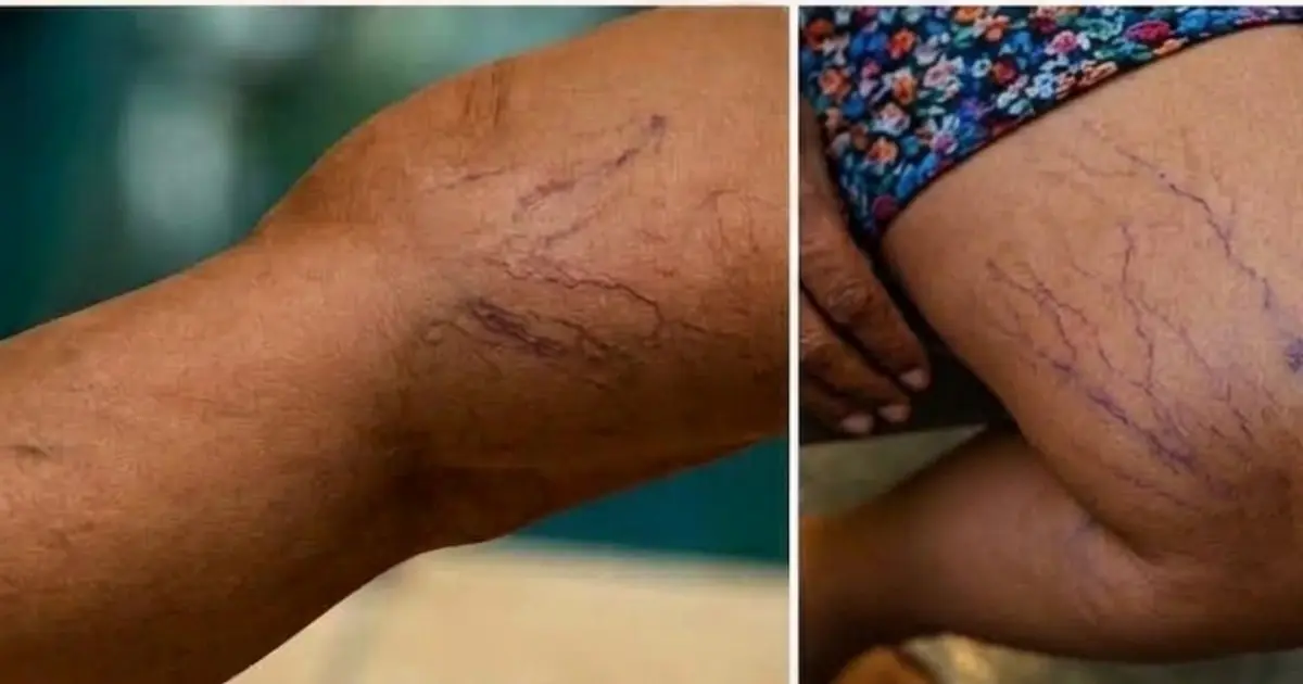 Notice Purple Veins Appearing on Your Legs? Here Are 6 Possible Reasons You Should Know