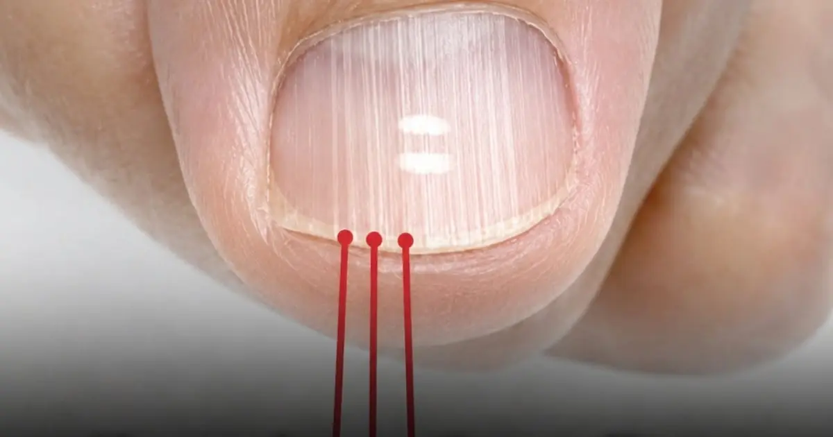 If You Notice These Vertical Lines on Your Nails After 40, Here’s What They Could Mean
