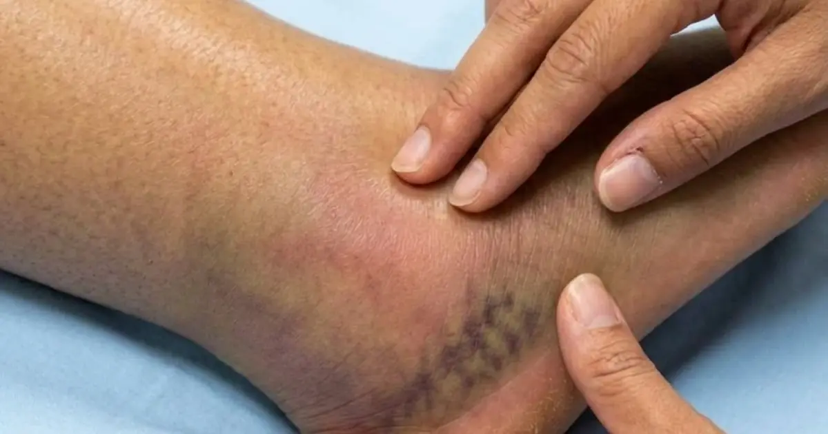 Your Swollen Legs May Be Telling You More Than You Think — Here’s What to Watch For