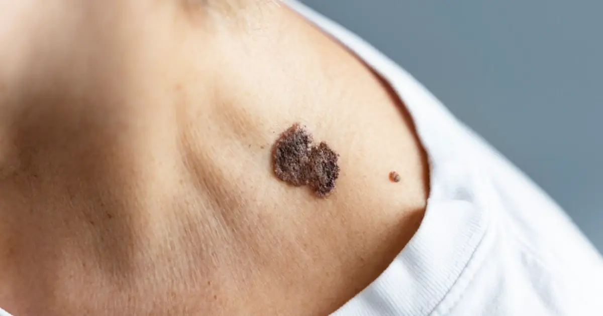 15 Possible Early Signs of Can.cer Your Body May Be Showing