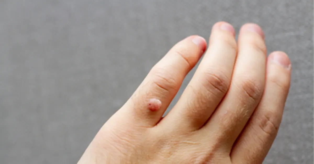 How to Identify 10 Types of Warts and the Best Ways to Treat Them
