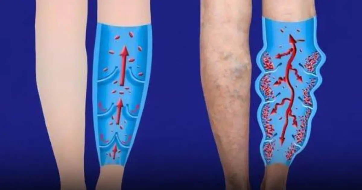 6 Simple Habits That May Help Improve Circulation and Support Vein Health