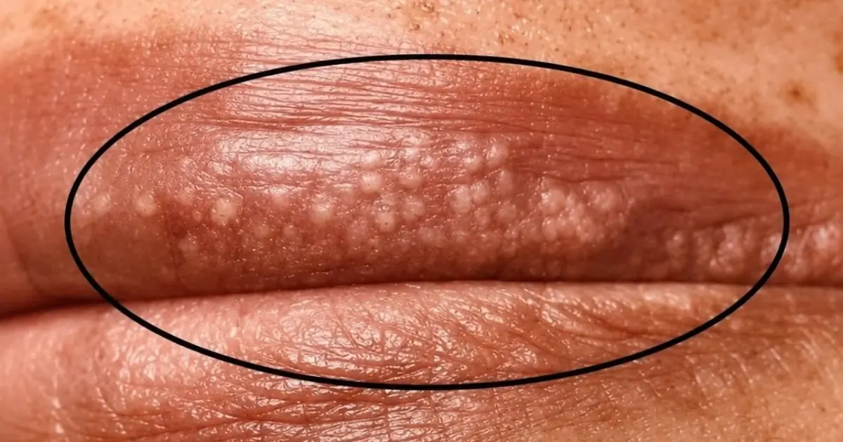 If These Small Bumps Appear on Your Lips, Here’s What They Could Mean