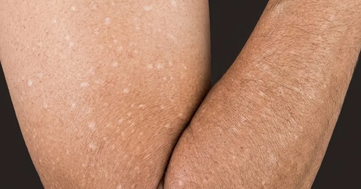 Have You Ever Wondered What Those Tiny White Spots on Your Arms or Legs Are? A Specialist Explains