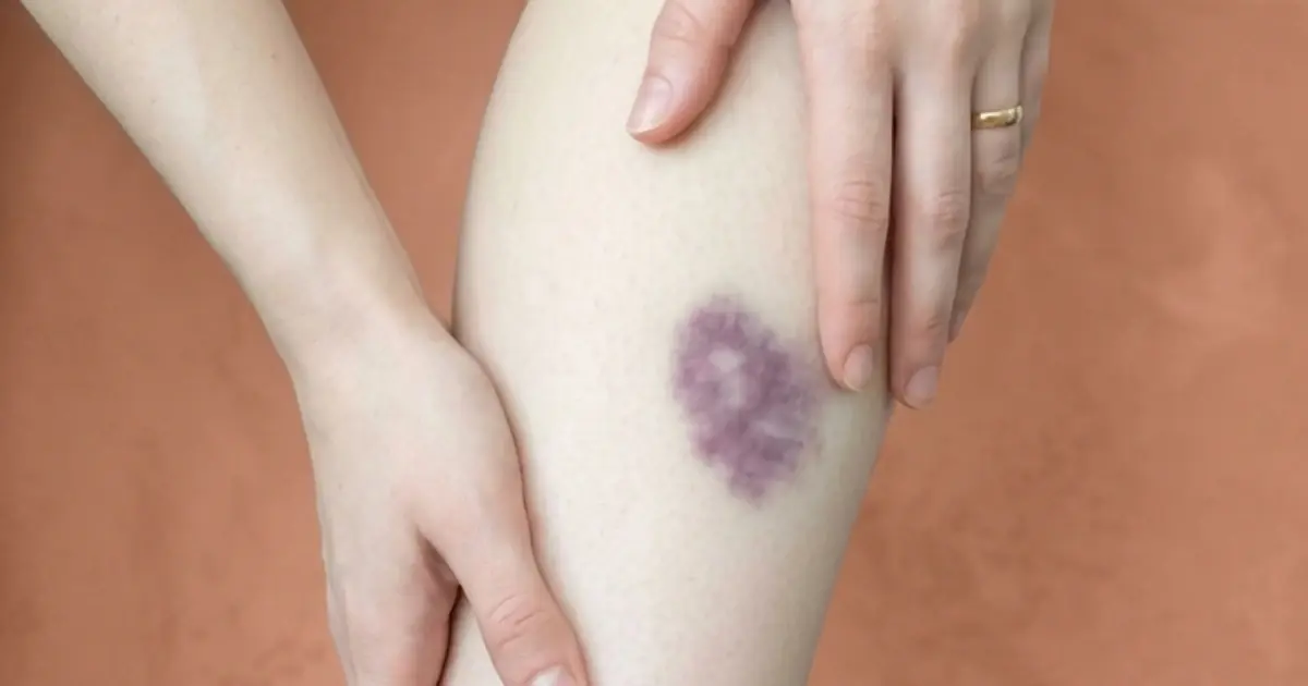 Getting Bruises for No Clear Reason? Here’s What Your Body Could Be Telling You