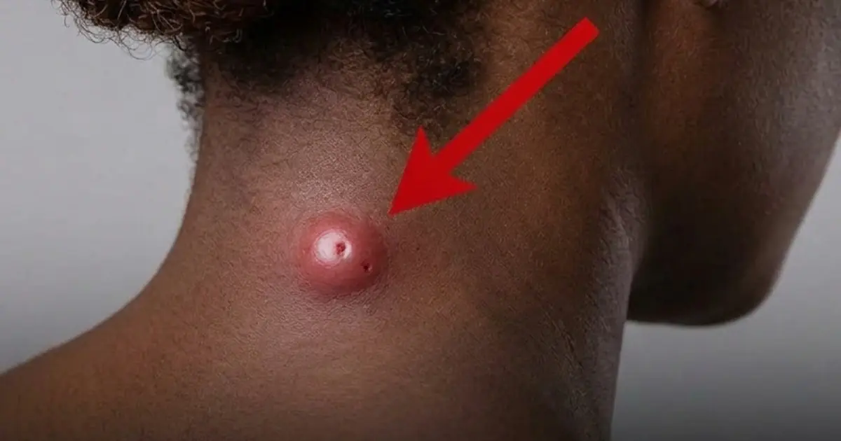 Found a Lump on Your Neck? Here’s When Doctors Say You Should Get It Checked