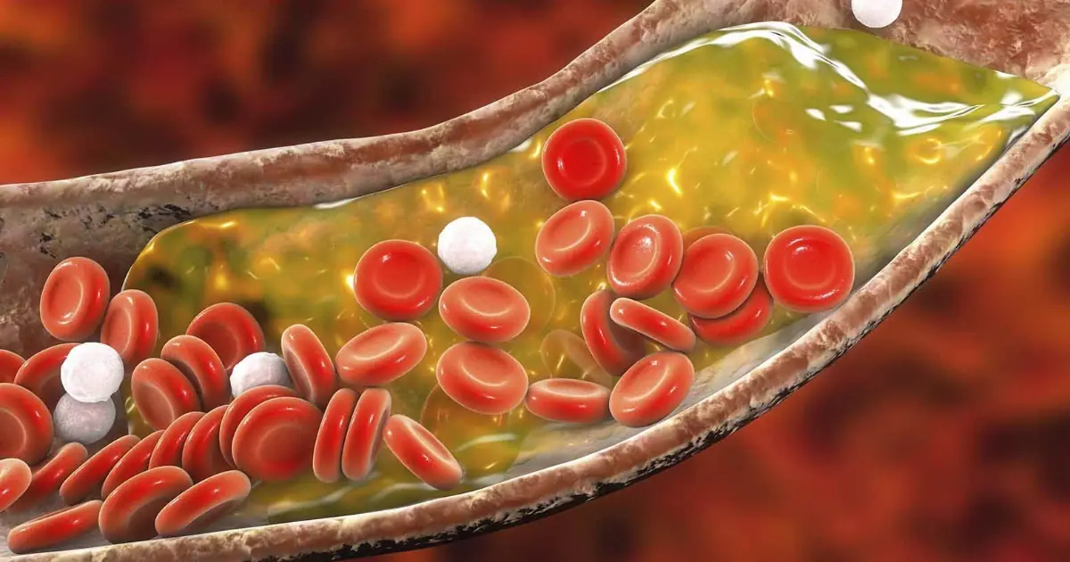 High Cholesterol Often Has No Symptoms - Here’s What You Should Know