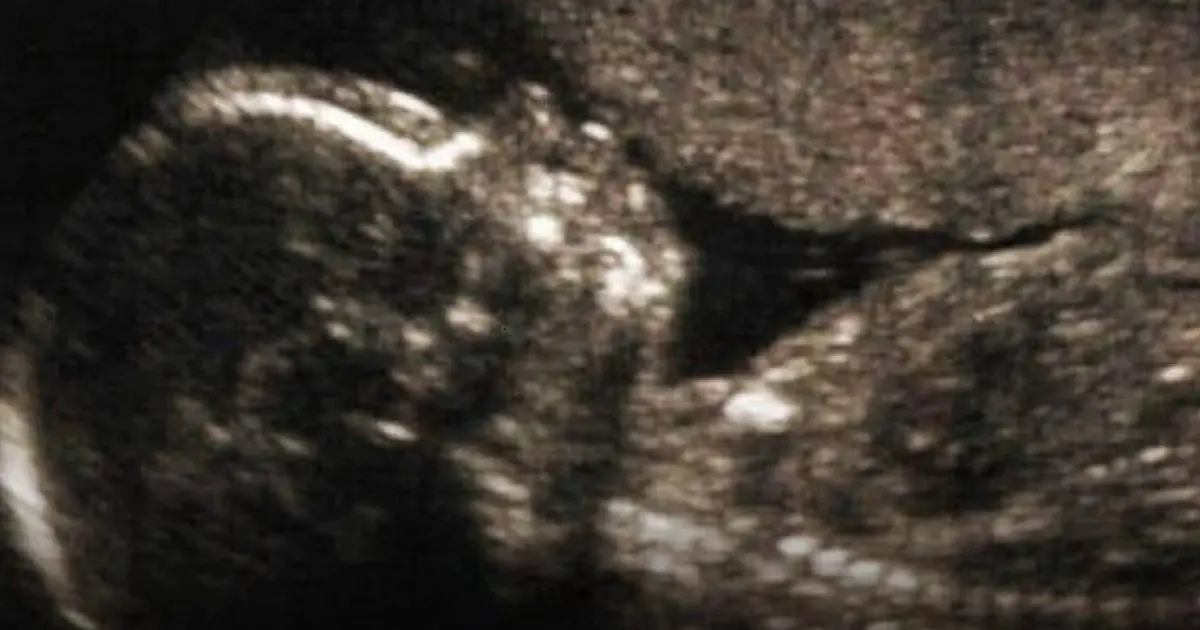 Scientists Explore Possible Causes of Autism Before Birth