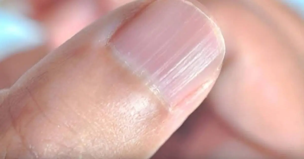 7 Nail Changes You Should Never Ignore: What Your Fingernails May Reveal About Your Health