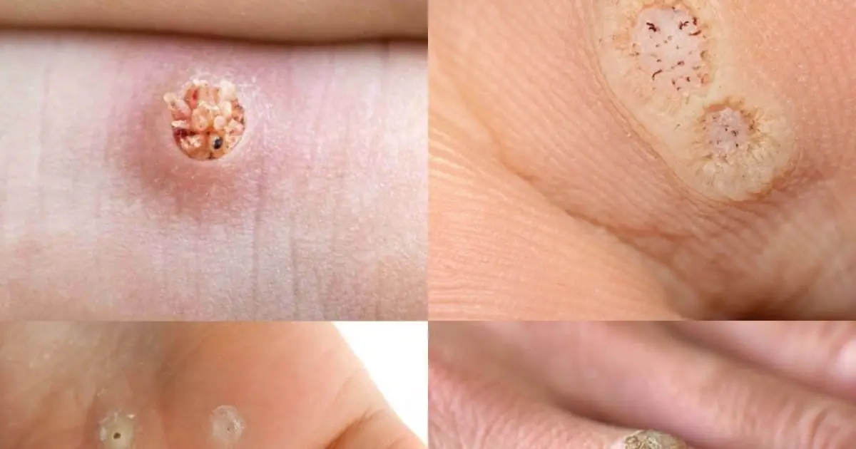 If You Get These Rough Bumps on Your Skin, You May Have a Common Viral Infection