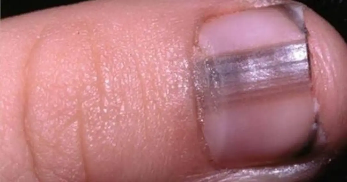 Your Nails May Be Sending You a Warning - 4 Changes You Shouldn’t Ignore