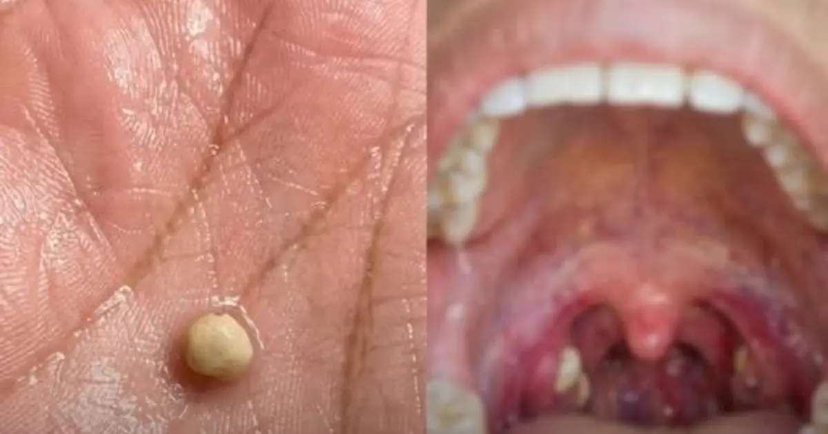 Suddenly Felt Like Something Was Stuck in My Throat… Swallowing Didn’t Help. Then a Strange Lump Came Out. What Was It?