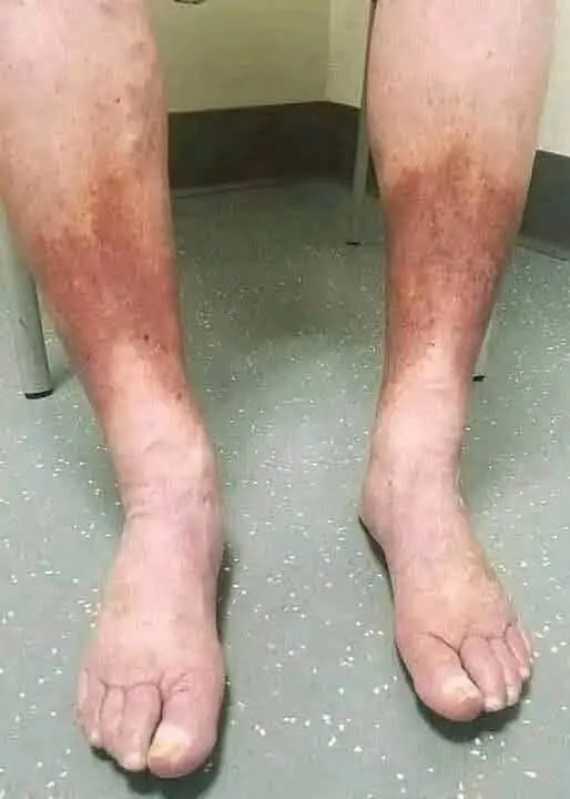 Swollen Legs and Dark Skin Changes: Warning Signs You Should Never Ignore