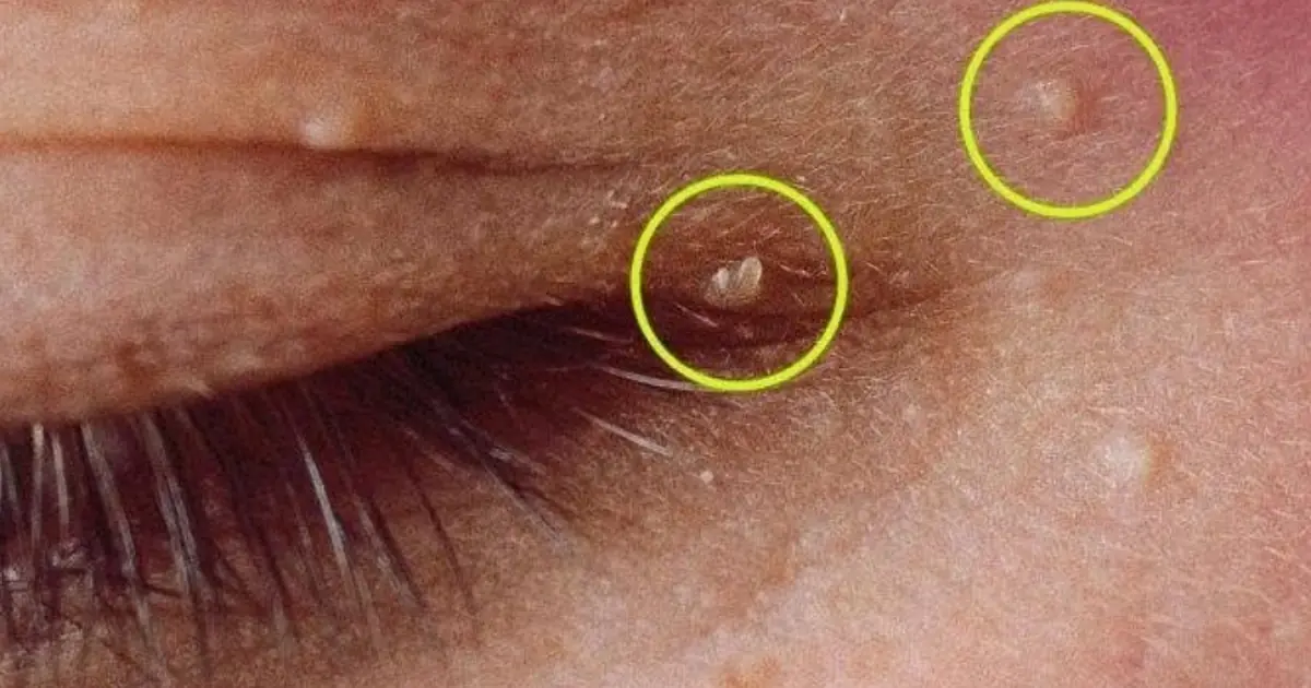 How to Get Rid of Milia: Understanding Those Tiny White Bumps Around the Eyes