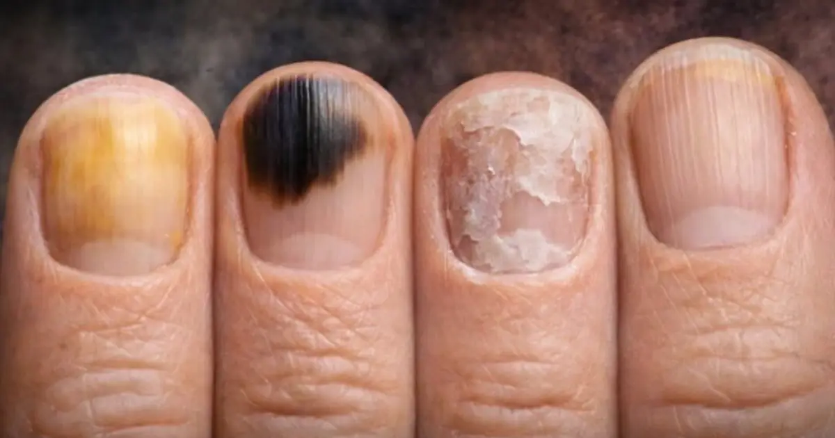Nail Discoloration and Lines: What Your Nails May Be Telling You