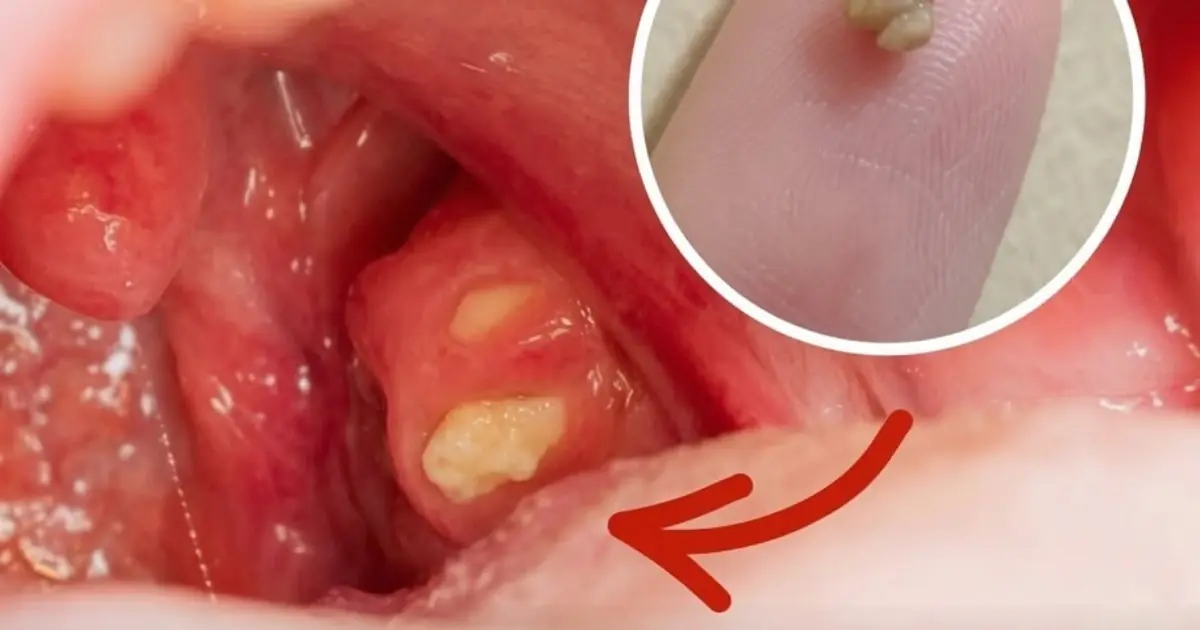 What Are Tonsil Stones? Understanding the Small White Lumps That Appear in Your Throat