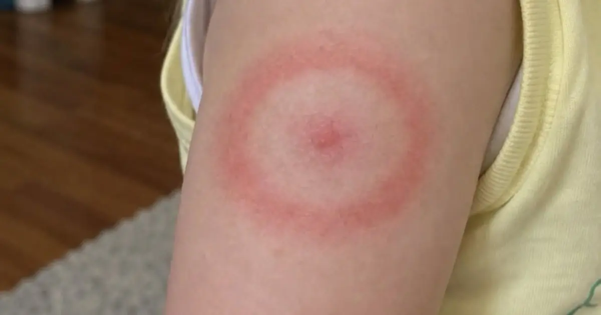 That Mysterious Red Ring on Your Child’s Skin Could Be More Than Just a Bug Bite