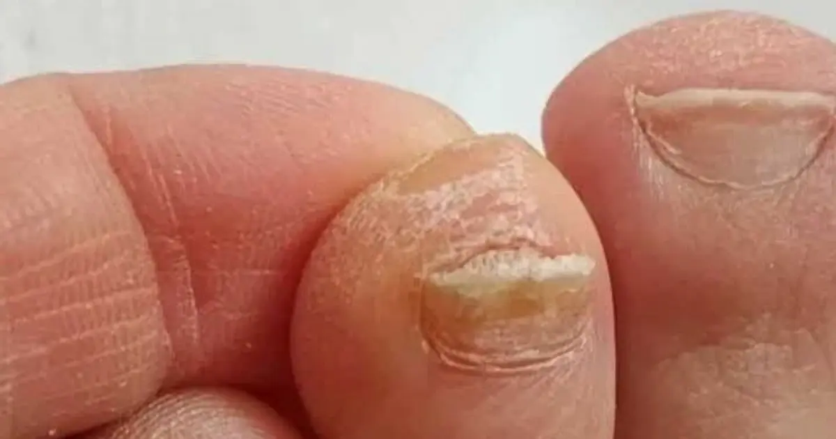 My Nana Swore by This Simple Trick for Making Thick Toenails Look Better - Here’s How It Works