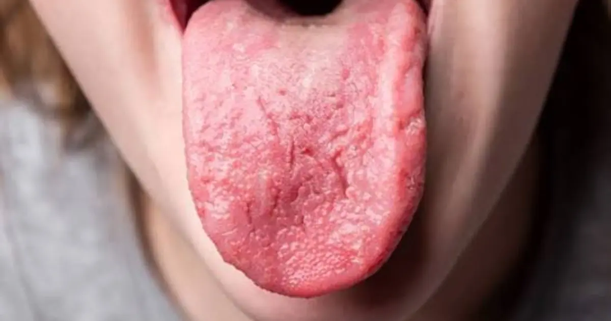 Look at Your Tongue: 5 Changes That May Reveal Clues About Your Health
