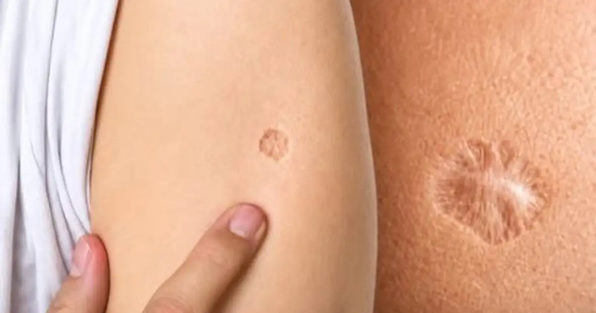 Why Do So Many People Have the Same Small Scar? The Mystery Behind a Global Mark