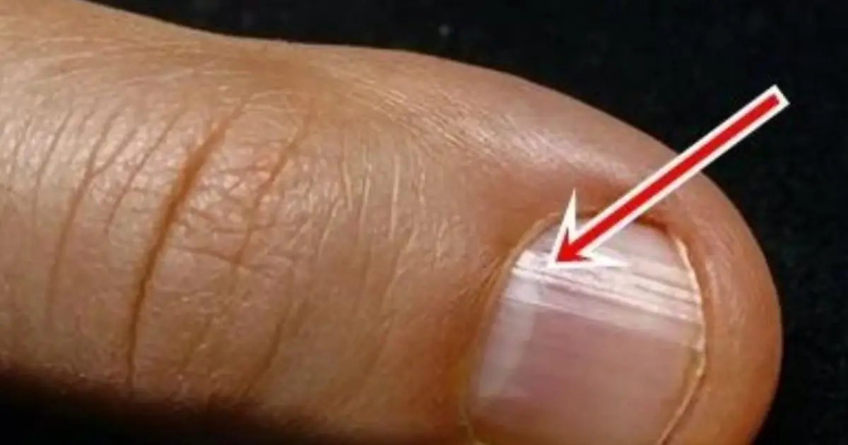 Your Nails Could Be Sending Warning Signs — Especially After 40