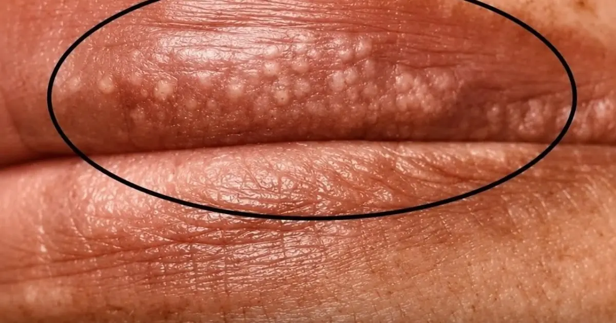 White Spots on Lips or Intimate Area? Don't Ignore These Warning Signs