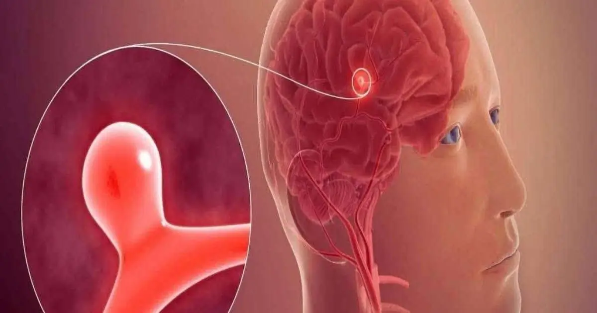 Brain Aneurysm: Warning Signs and Symptoms You Should Never Ignore