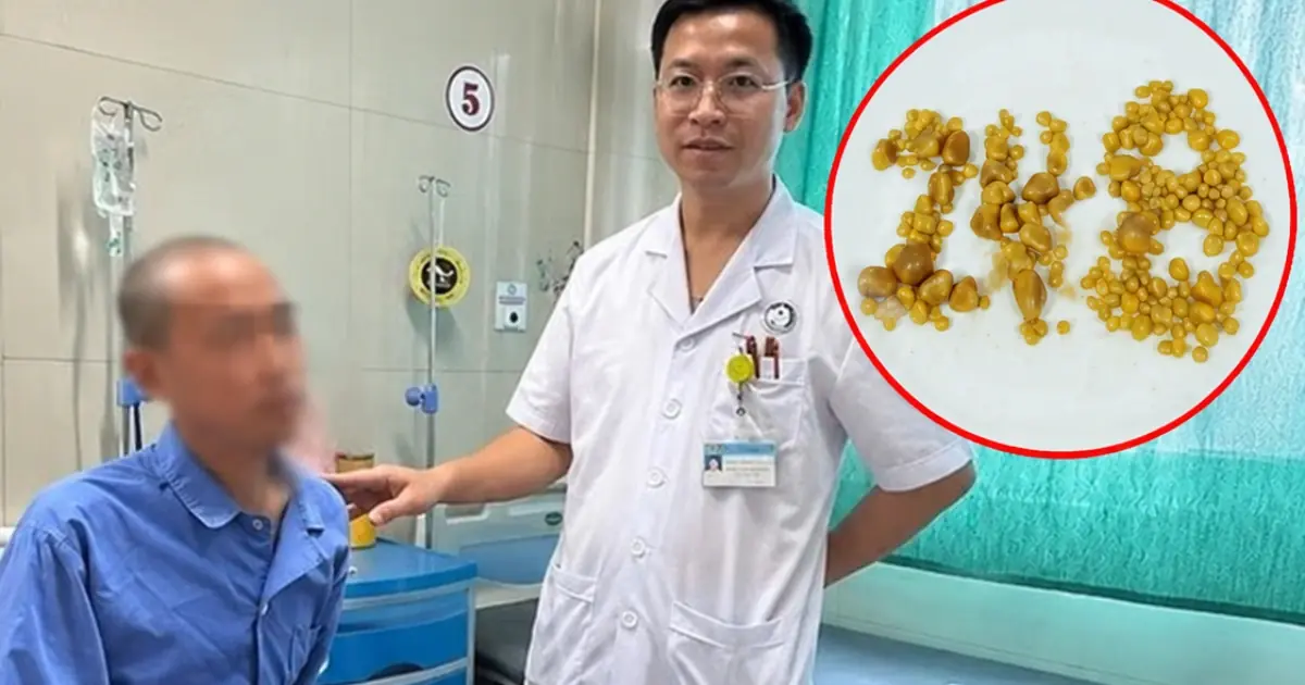 Doctors Remove More Than 200 Gallstones From a 26-Year-Old Man — His Daily Habits Shocked Many