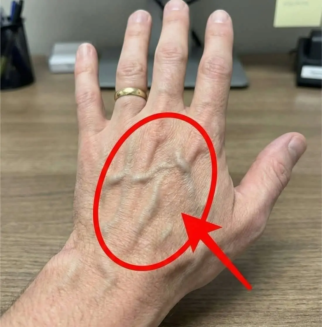 Visible Veins on Your Hands: What Do They Really Mean?