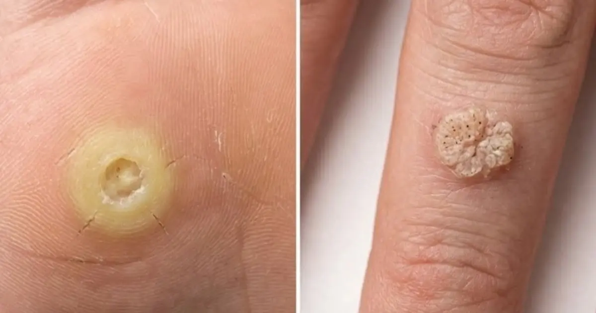 Warts or Skin Tags? Here's the Safest Way to Get Rid of Them