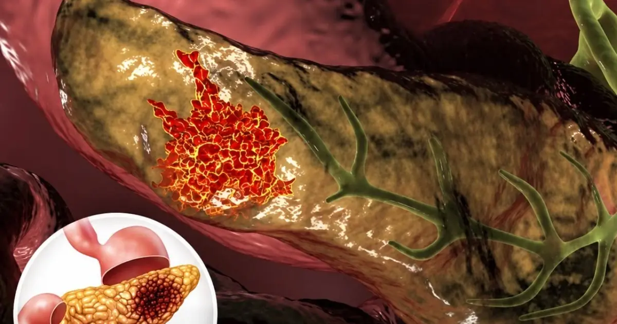 These 10 warning signs could appear months before pancreatic can.cer is diagnosed.