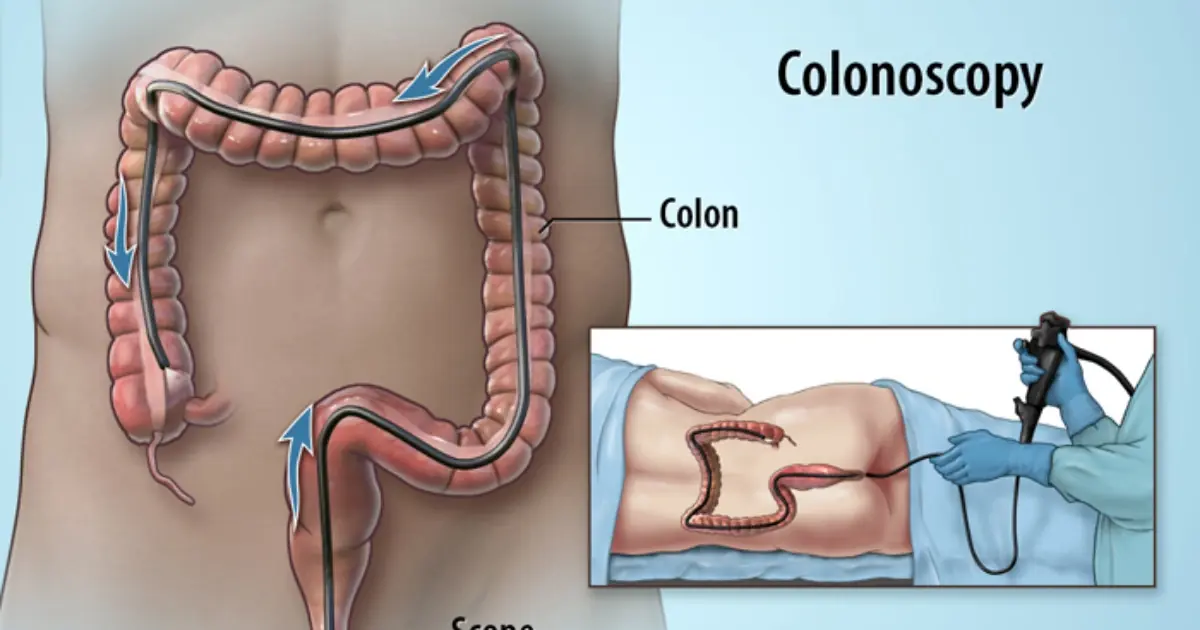 Facing a Colonoscopy? Here Are the Questions You Should Ask Your Doctor First