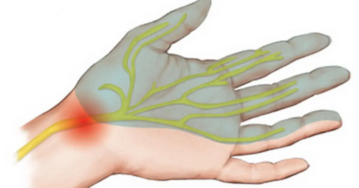Do Your Hands Go Numb or “Fall Asleep”? Here’s Why It Happens and What Actually Helps