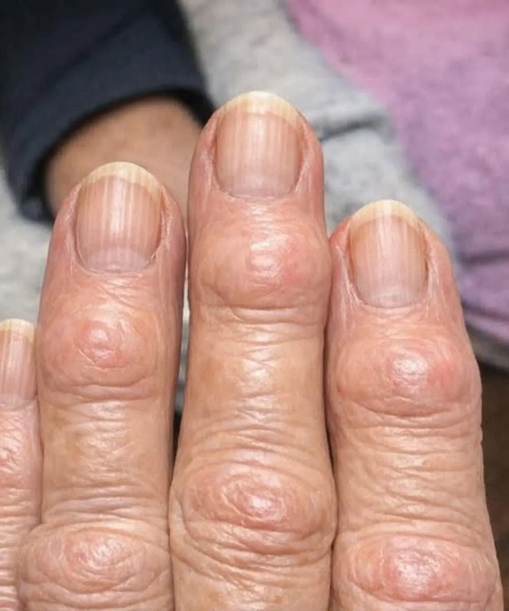 My Grandma Has These Hard Bumps Forming on Her Finger Joints Near the Nails. Why Is This Spreading? Are These Hard Bumps on Your Fingers a Warning Sign?